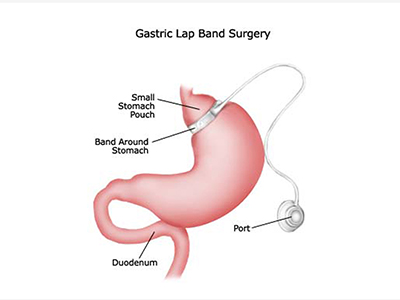 Gastric Banding Surgery in Qatar 