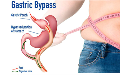 Gastric Bypass Surgery in Qatar