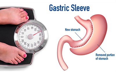 Gastric Sleeve Surgery in Qatar